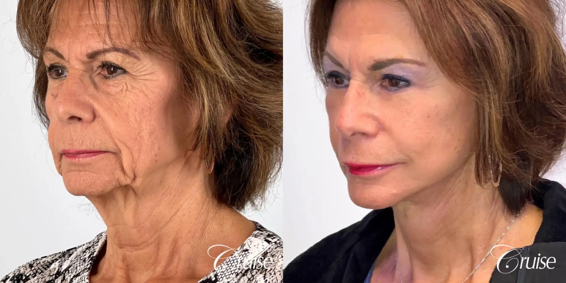 Face & Neck Lift & Rejuvenation - Before and After 2