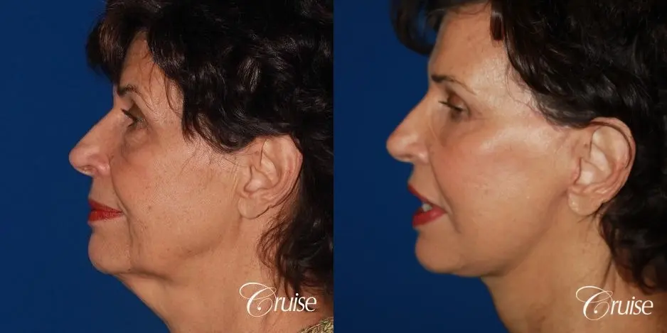 facelift surgery dr. cruise - Before and After 2