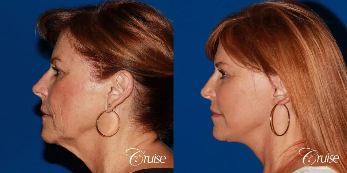facial rejuvenation orange county ca - Before and After 2