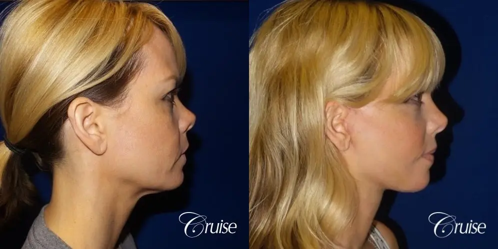 Lower Facelift 45 yrs old - Before and After 3