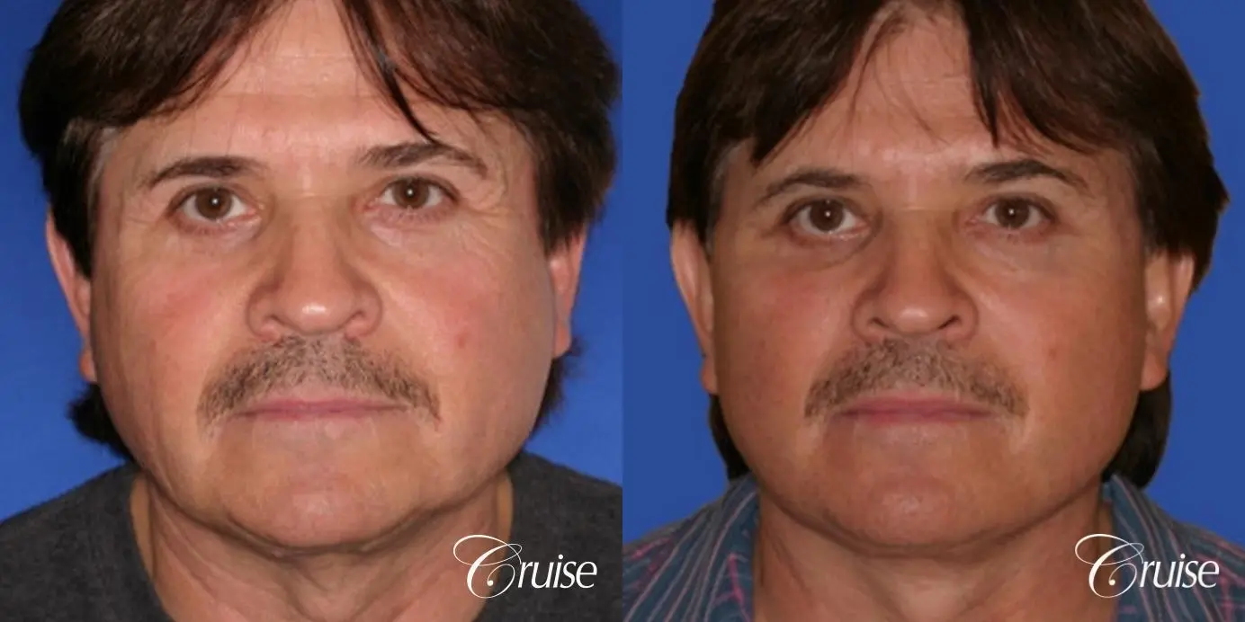 Facelift in Newport Beach, CA - Before and After 1