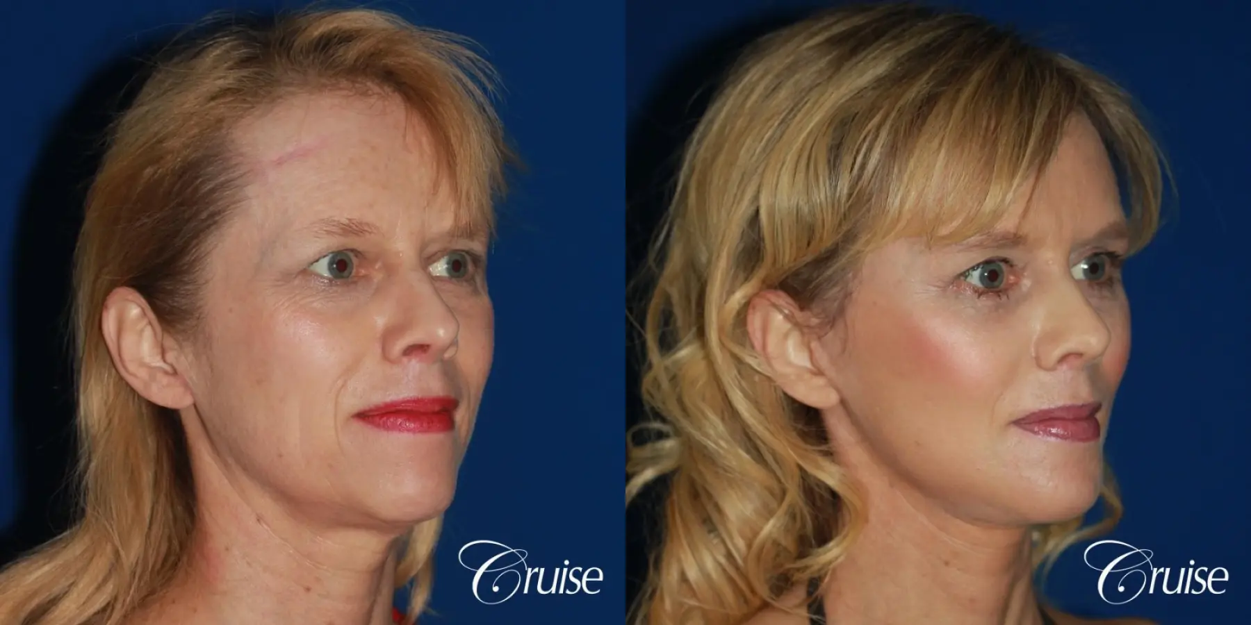 facial rejuvenation newport beach ca - Before and After 3