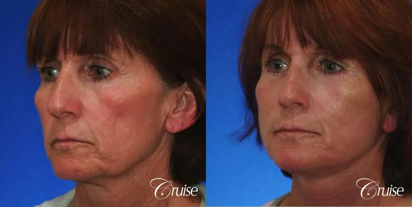 lower facelift newport beach ca - Before and After 2