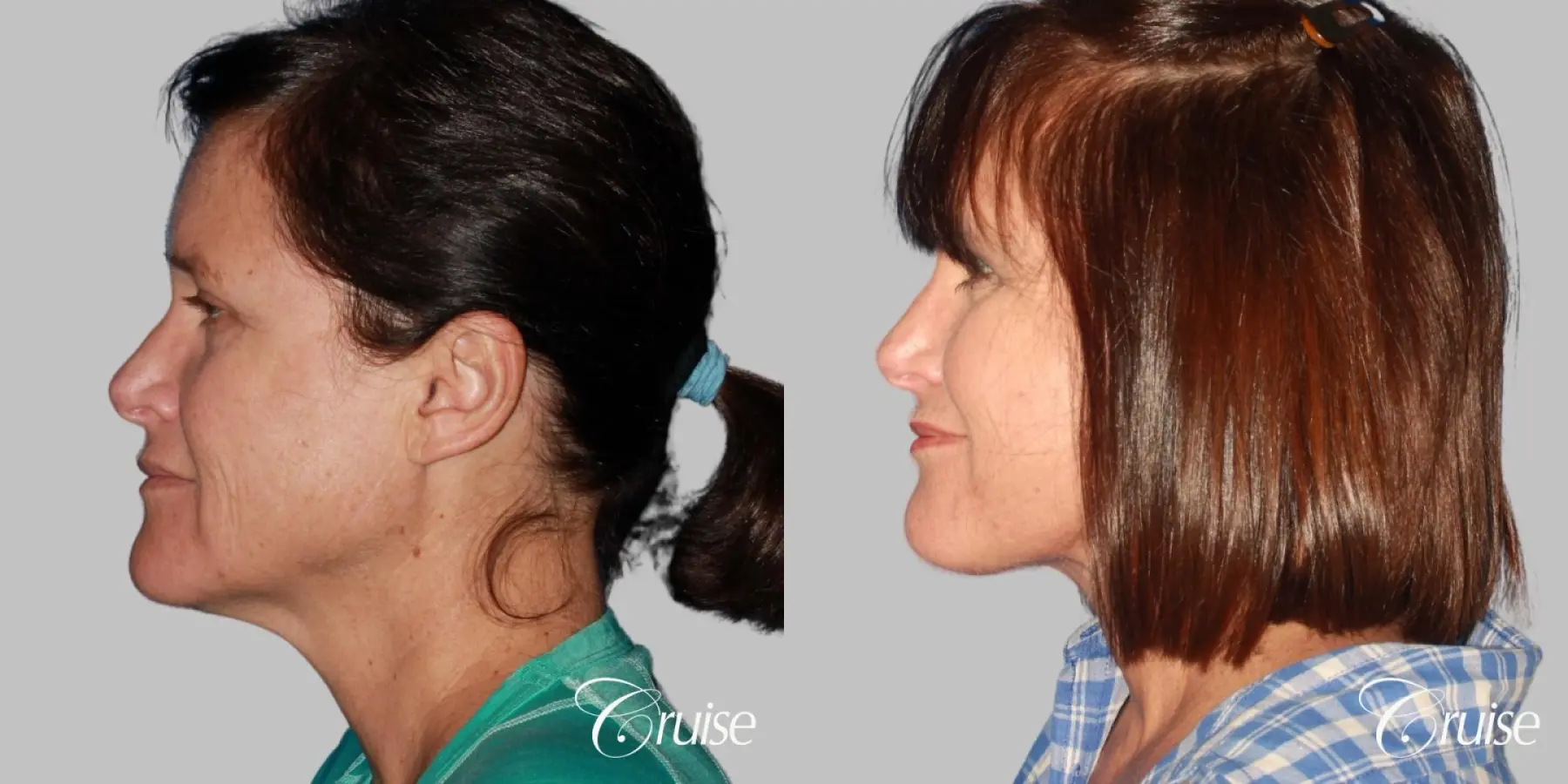 Mid-Facelift, Neck Tightening - Before and After 2