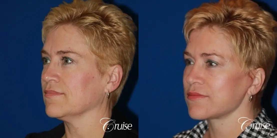 Facelift in Newport Beach, CA - Before and After 3