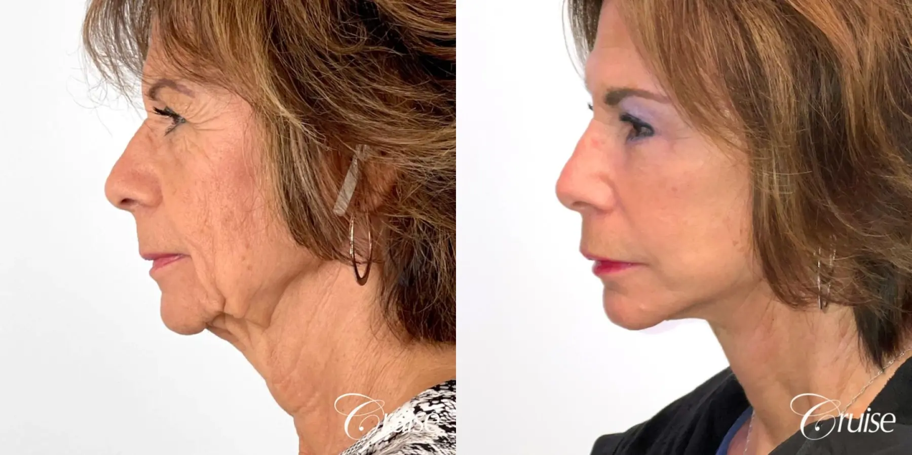 Face & Neck Lift & Rejuvenation - Before and After 3