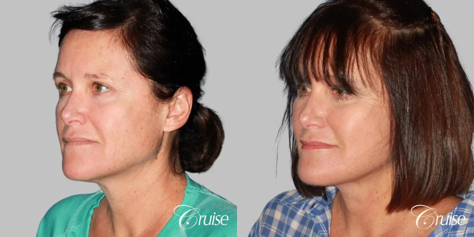 Mid-Facelift, Neck Tightening - Before and After 3