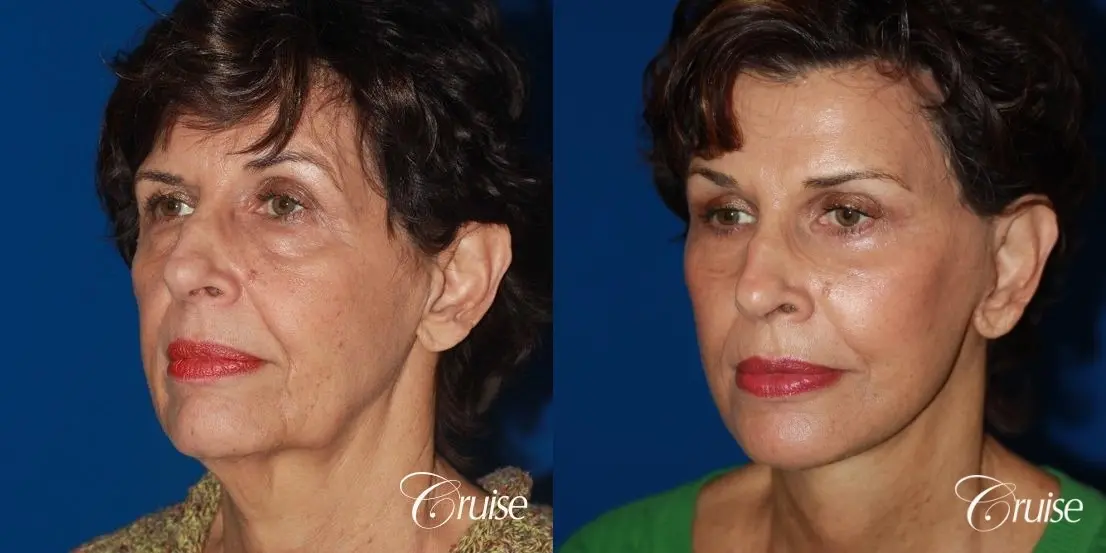 facelift surgery dr. cruise - Before and After 3