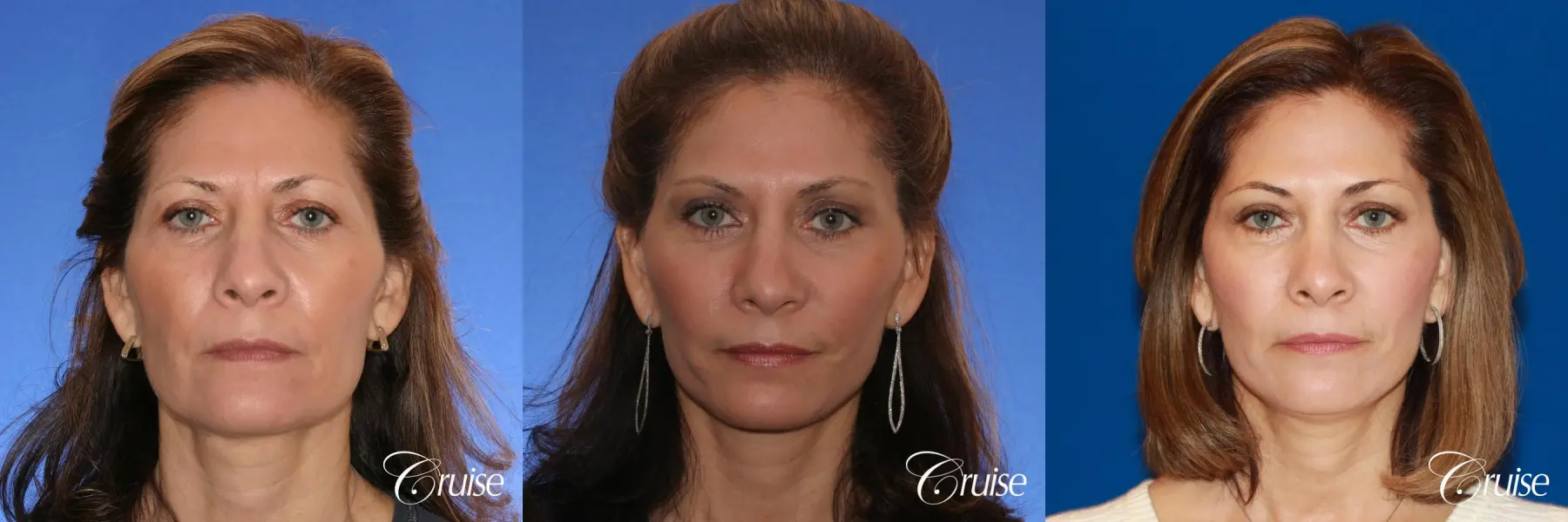 facelift with fat transfer newport beach - Before and After