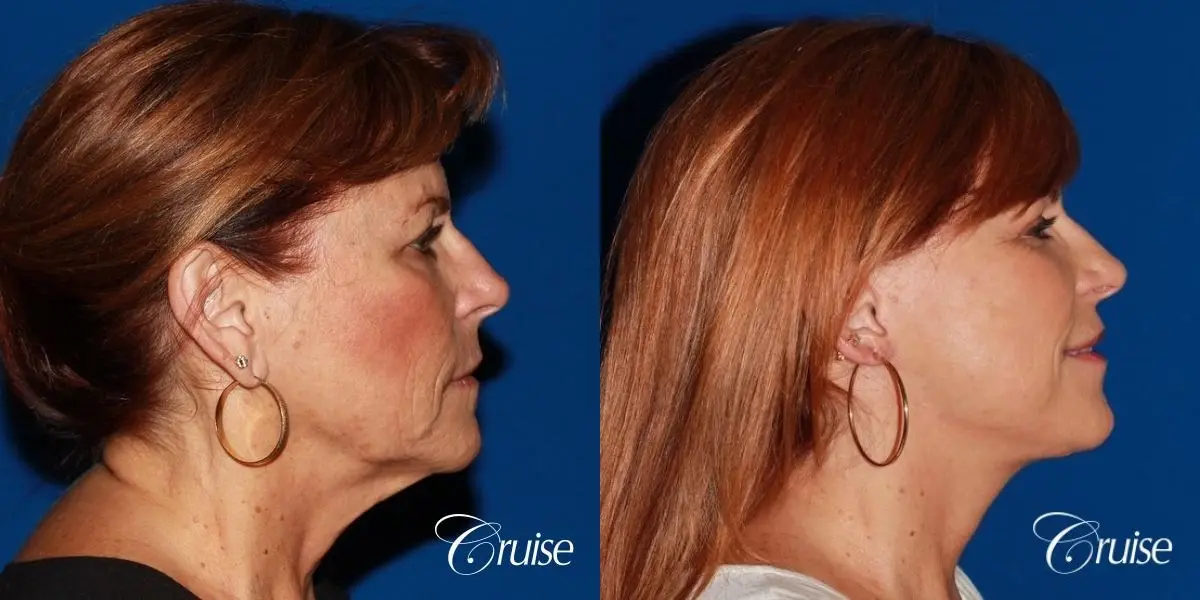 facial rejuvenation orange county ca - Before and After 5