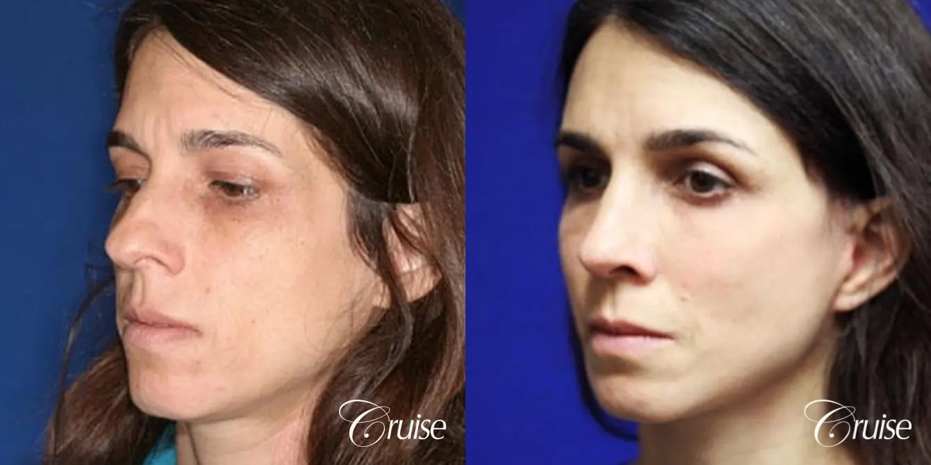 complete facial rejuvenation orange county - Before and After 3