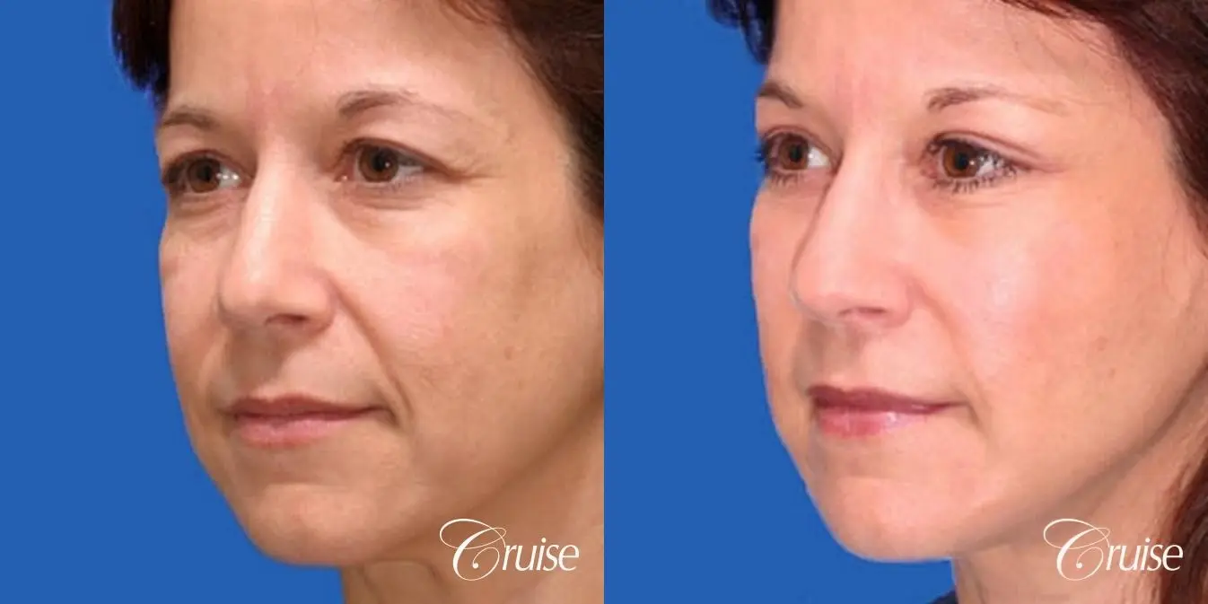 Facelift - Before and After 2