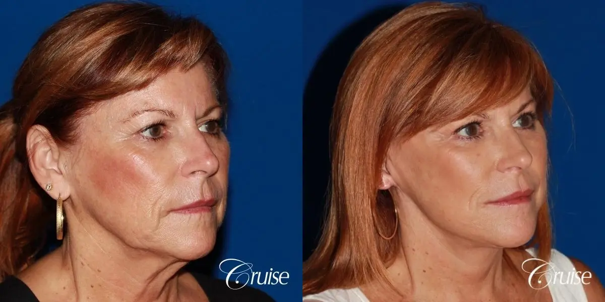 facial rejuvenation orange county ca - Before and After 4