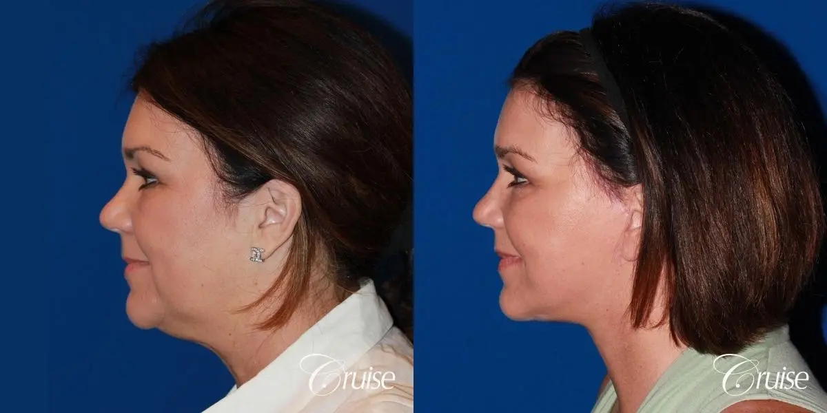 midface with lower face and neck lift orange county - Before and After 2