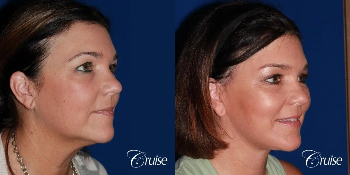 midface with lower face and neck lift orange county - Before and After 4