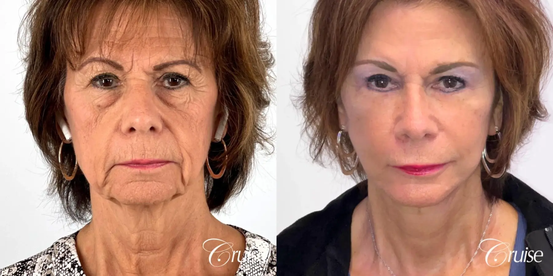 Face & Neck Lift & Rejuvenation - Before and After 1
