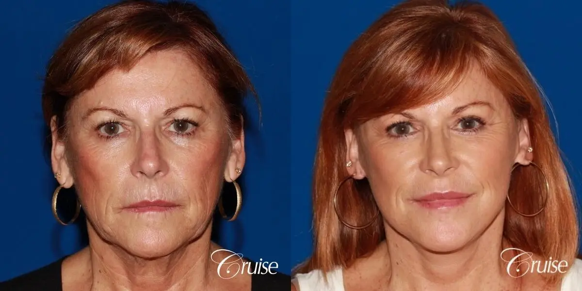 facial rejuvenation orange county ca - Before and After