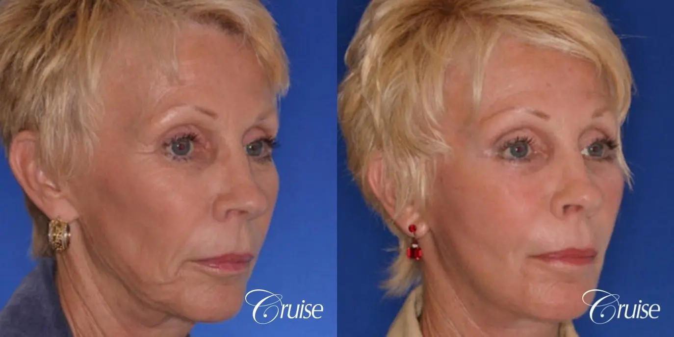 Facelift - Before and After 2