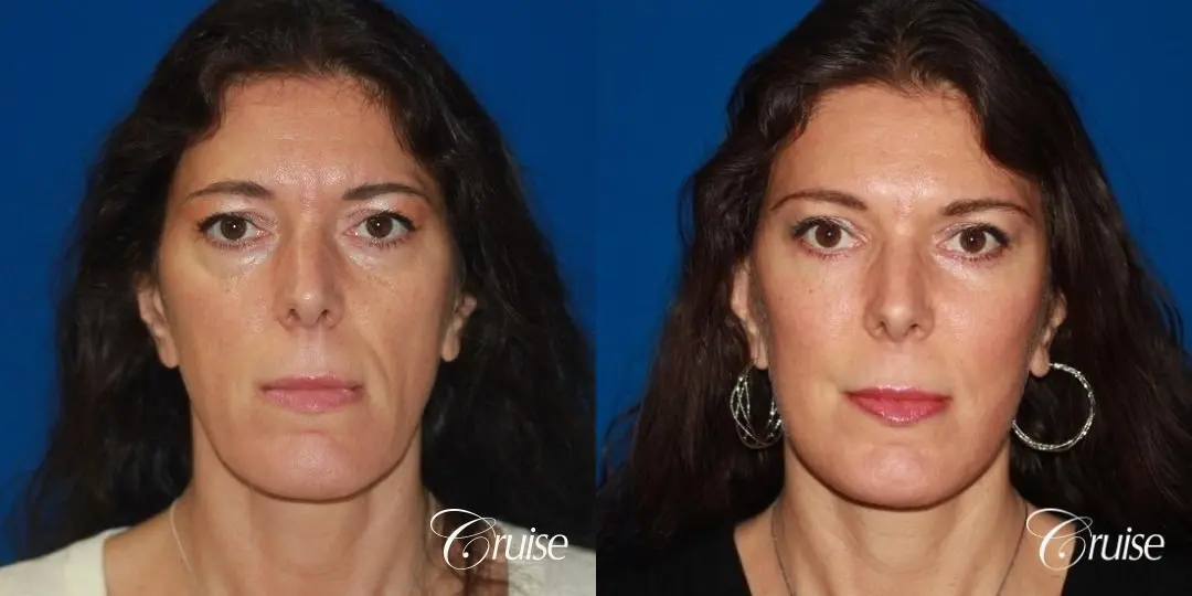 Facelift in Newport Beach, CA - Before and After 1