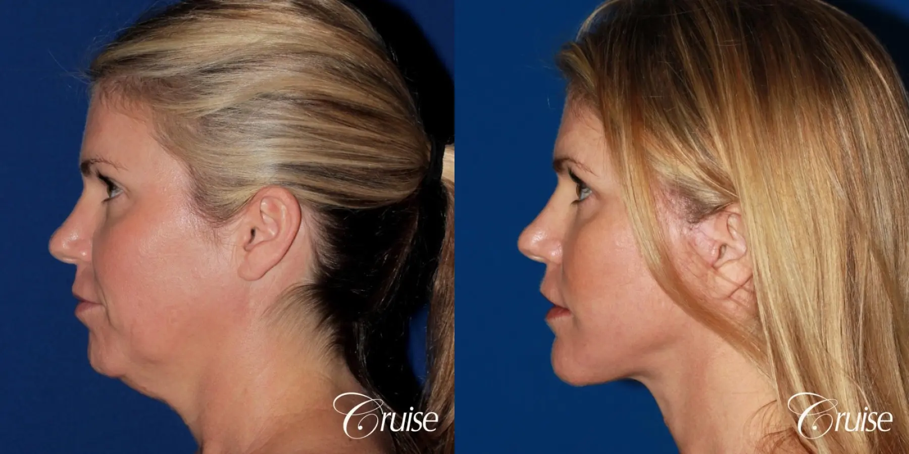 lower facelift with chin liposuction - Before and After 2
