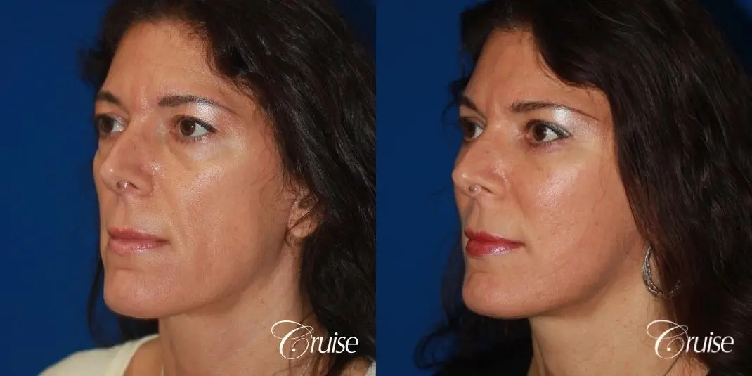 Facelift in Newport Beach, CA - Before and After 3
