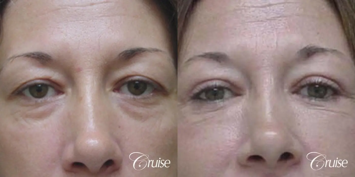 Fat Transfer - Lower Lids, Tear Trough - Before and After  