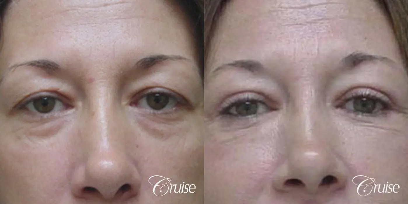 Fat Transfer - Lower Lids, Tear Trough - Before and After 1