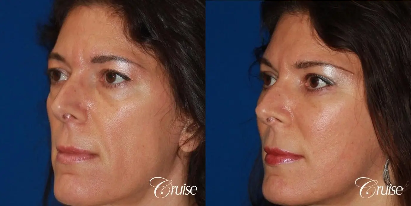 Fat Transfer - Forehead, Temple, Tear Trough, Lower Lids, Cheeks - Before and After 2