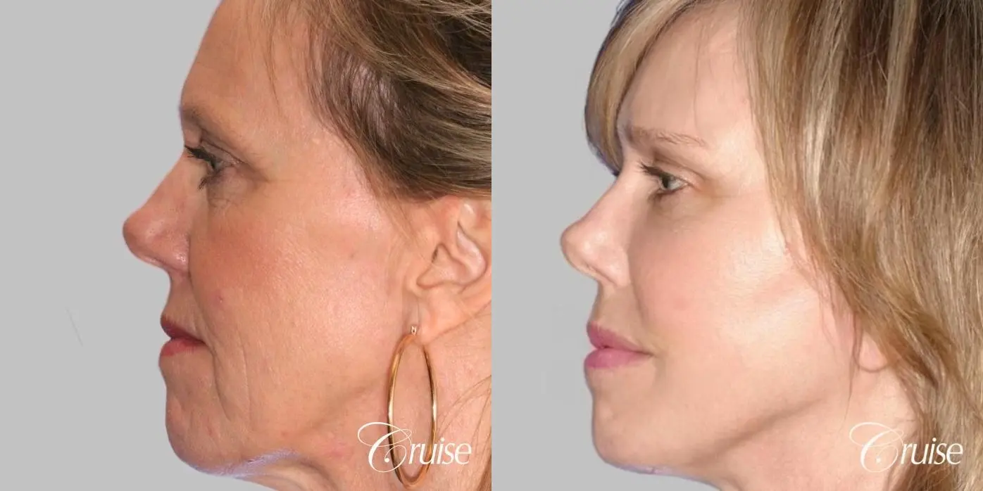 Female Facelift, NeckLift, Neck Midline Plication, Fat Transfer - Before and After 3