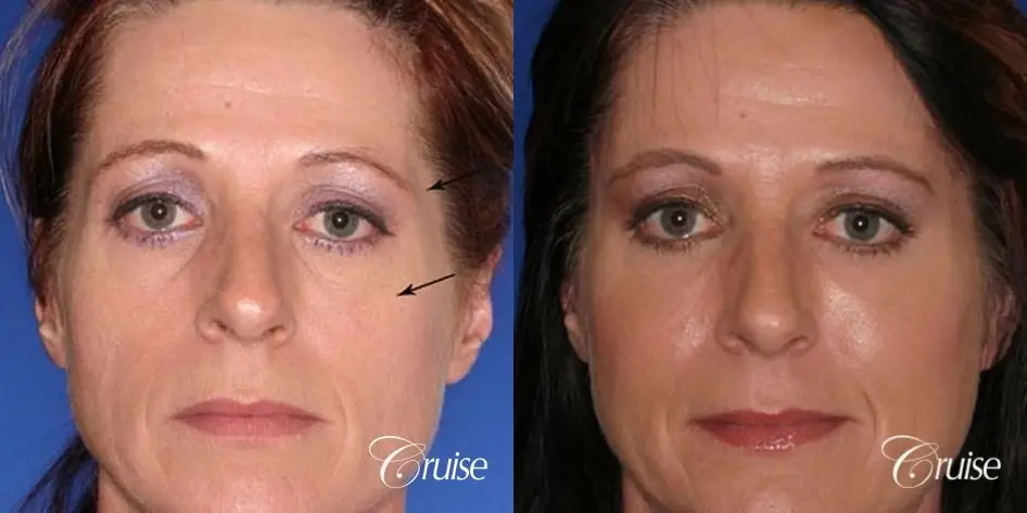 Amazing fat transfer results - Before and After