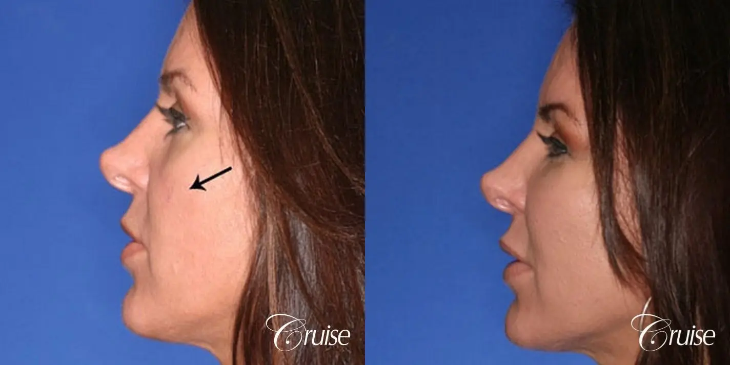 Fat Transfer - Temple, Tear Trough, Lower Lids, Cheeks - Before and After 2