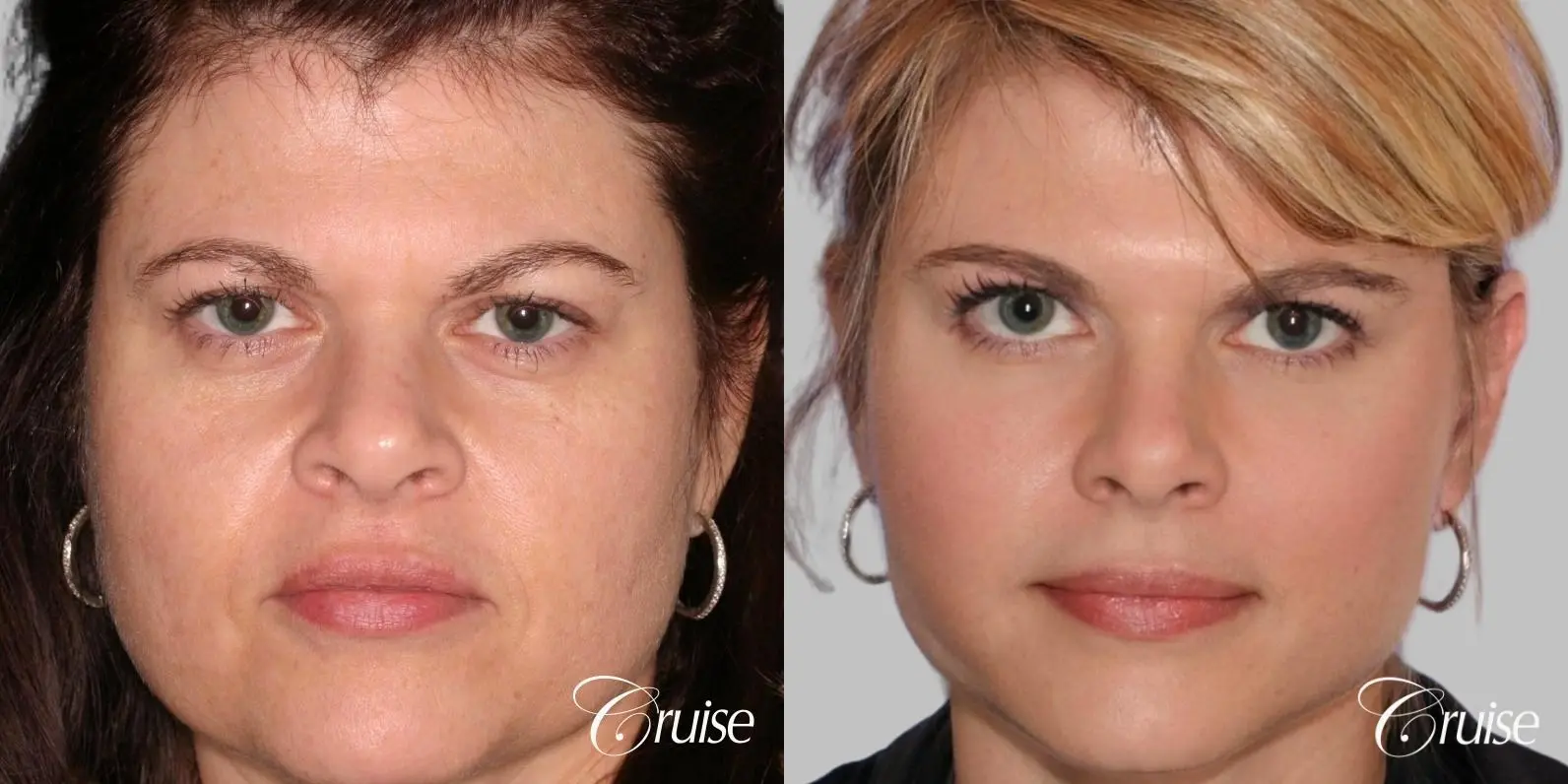 Facelift, Necklift, Temple Lift, Upper Eyelid Surgery, Fat Transfer, Buckle Fat Removal - Before and After 1