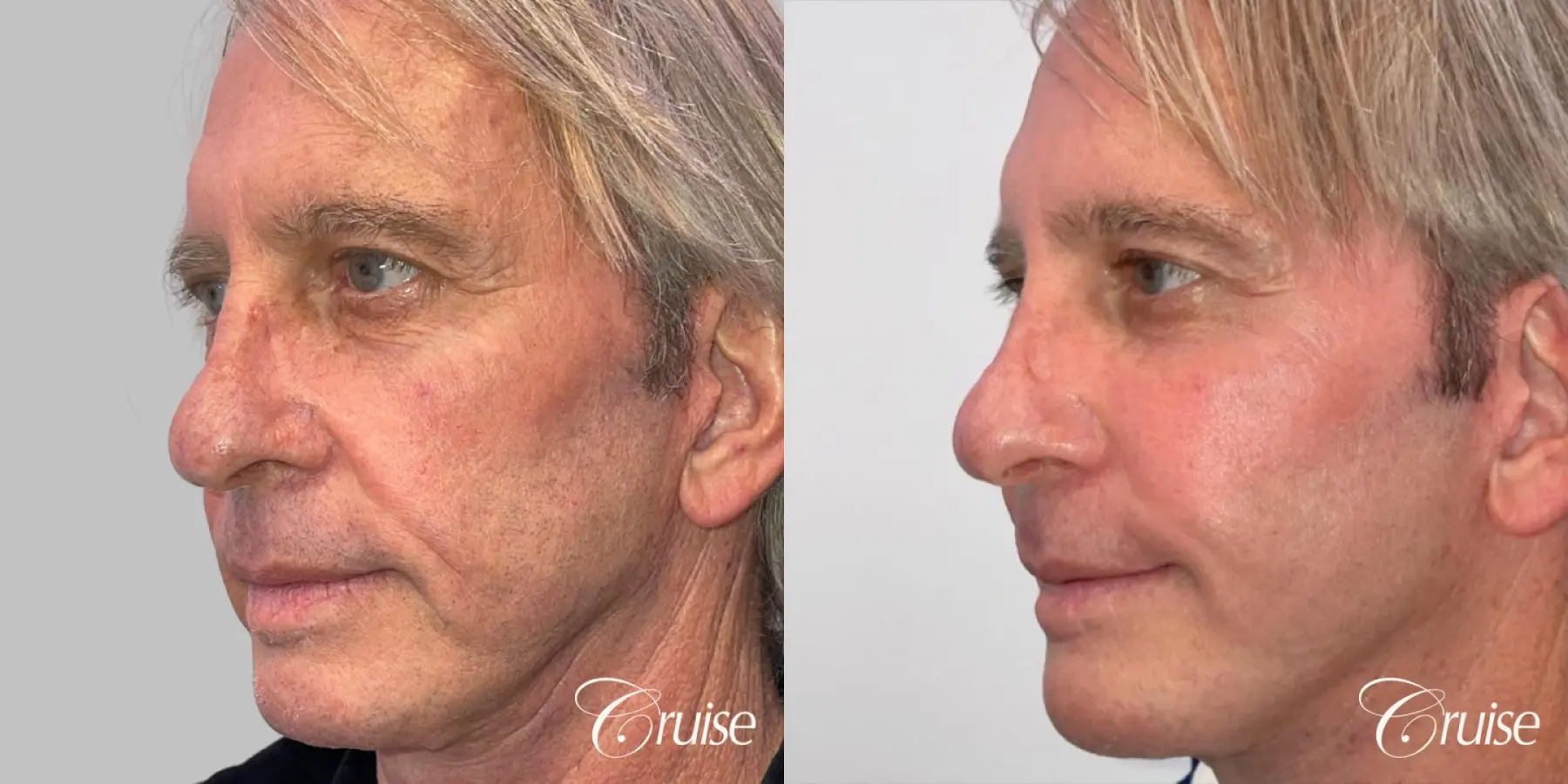 Fat Transfer - Cheeks, Tear Trough, Nasal Labial Folds - Male Patient - Before and After 3