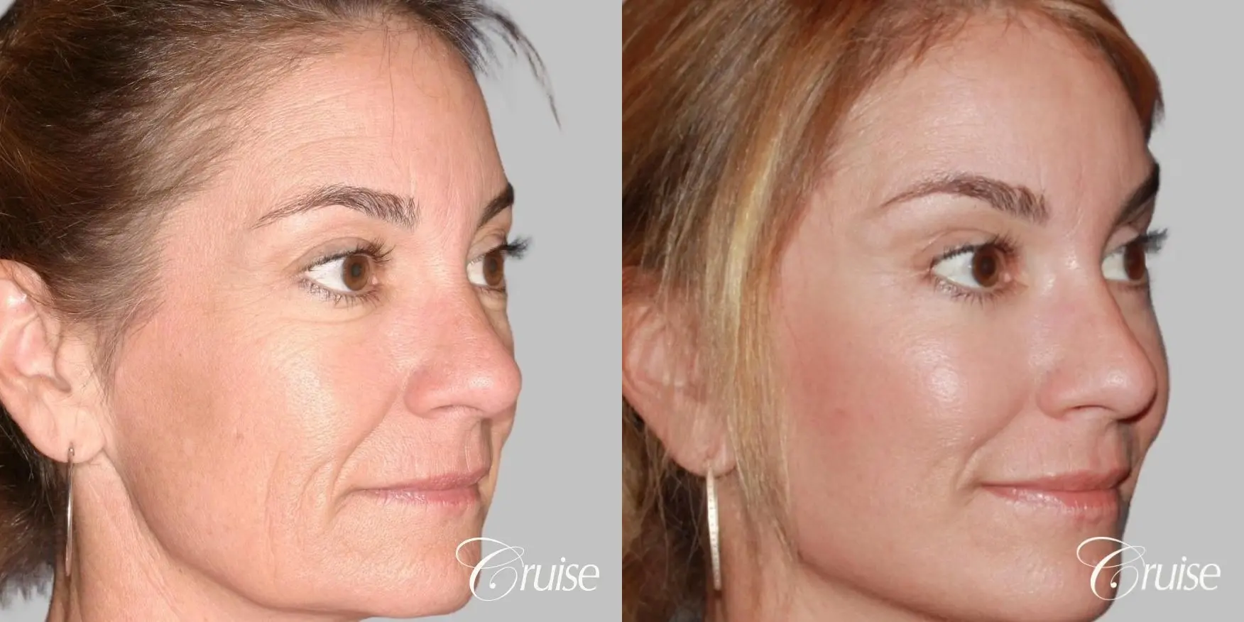 Female - Facelift, Neck Tightening, Fat Transfer - Before and After 2