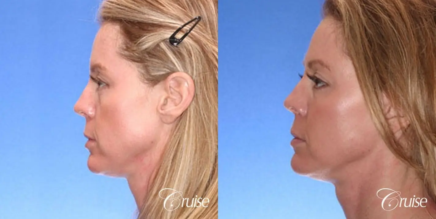 Fat Transfer - Temple, Tear Trough, Lower-Lids, Cheeks - Before and After 3