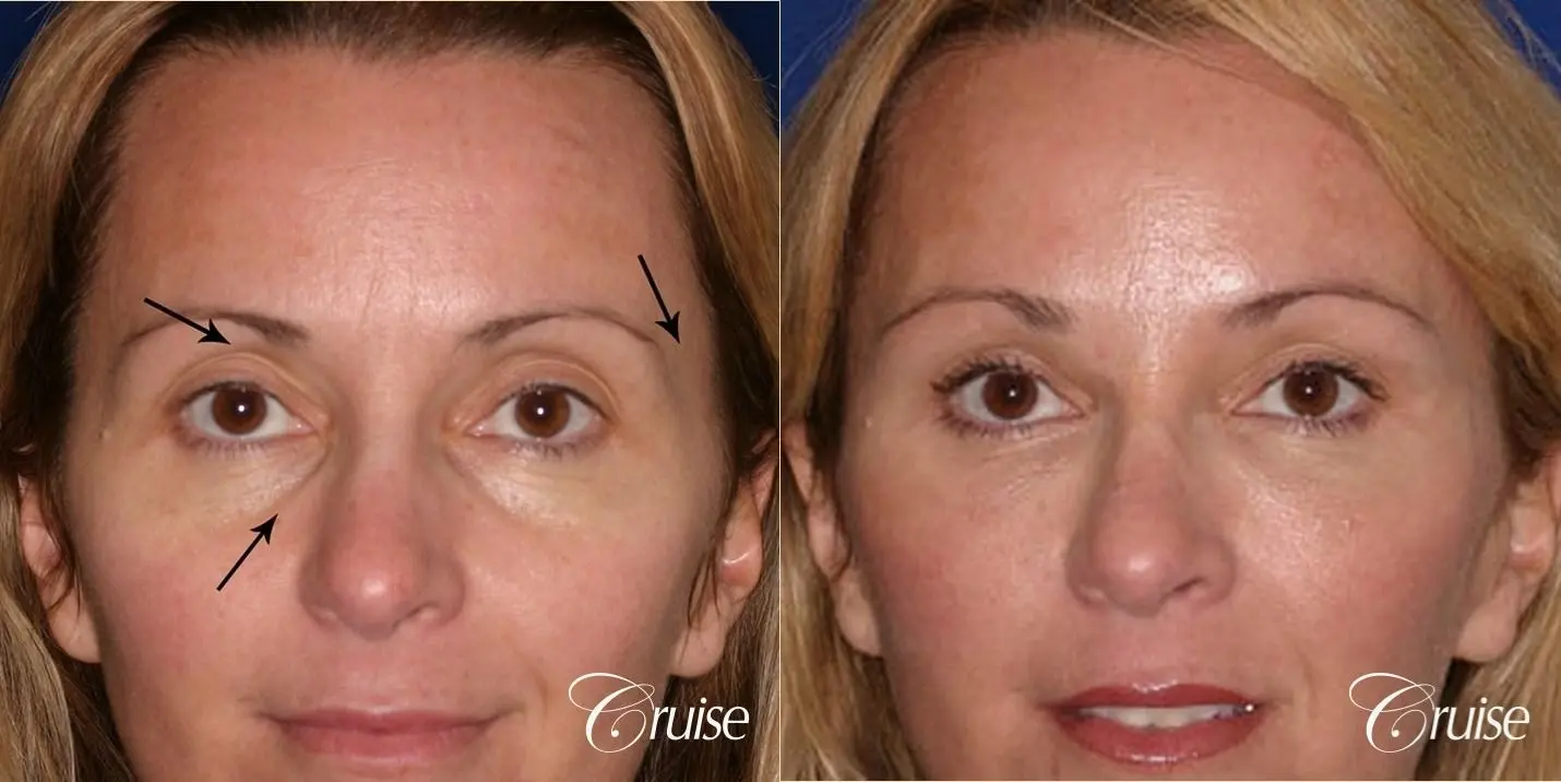 Fat Transfer - Tear Trough, Upper-Lids, Temple - Before and After 1