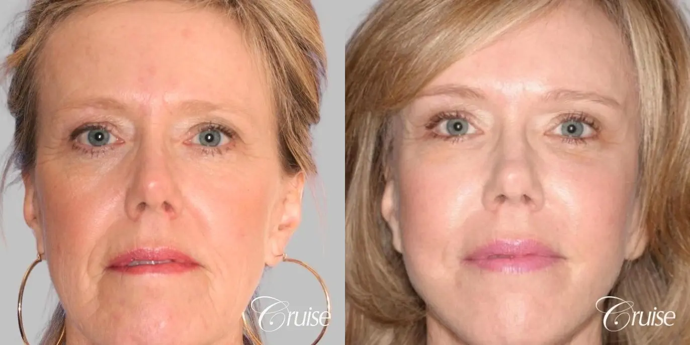 Female Facelift, NeckLift, Neck Midline Plication, Fat Transfer - Before and After  