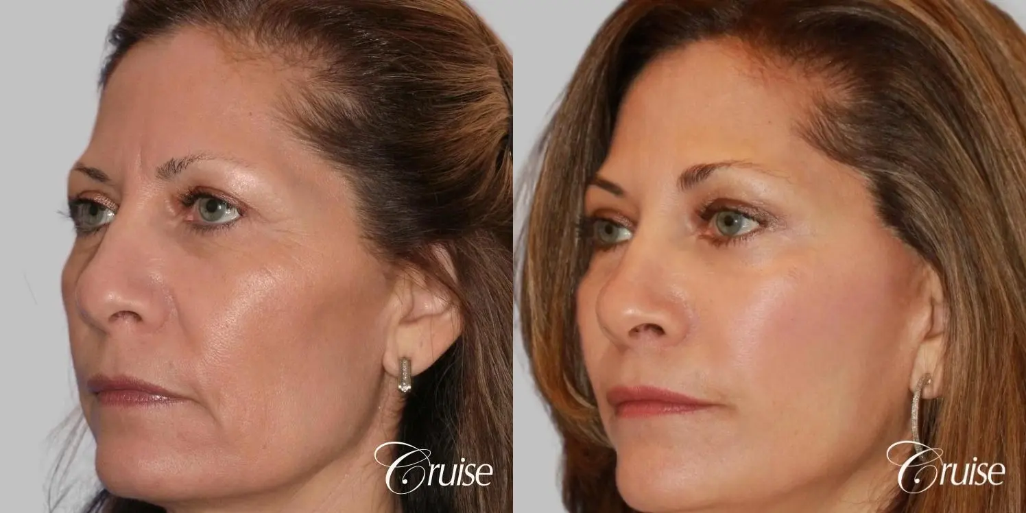 Face Lift, Fat Transfer, Temple Lift - Before and After 2