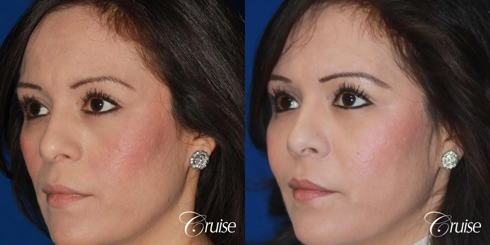 Fat Transfer - Face: Patient 25 - Before and After 3