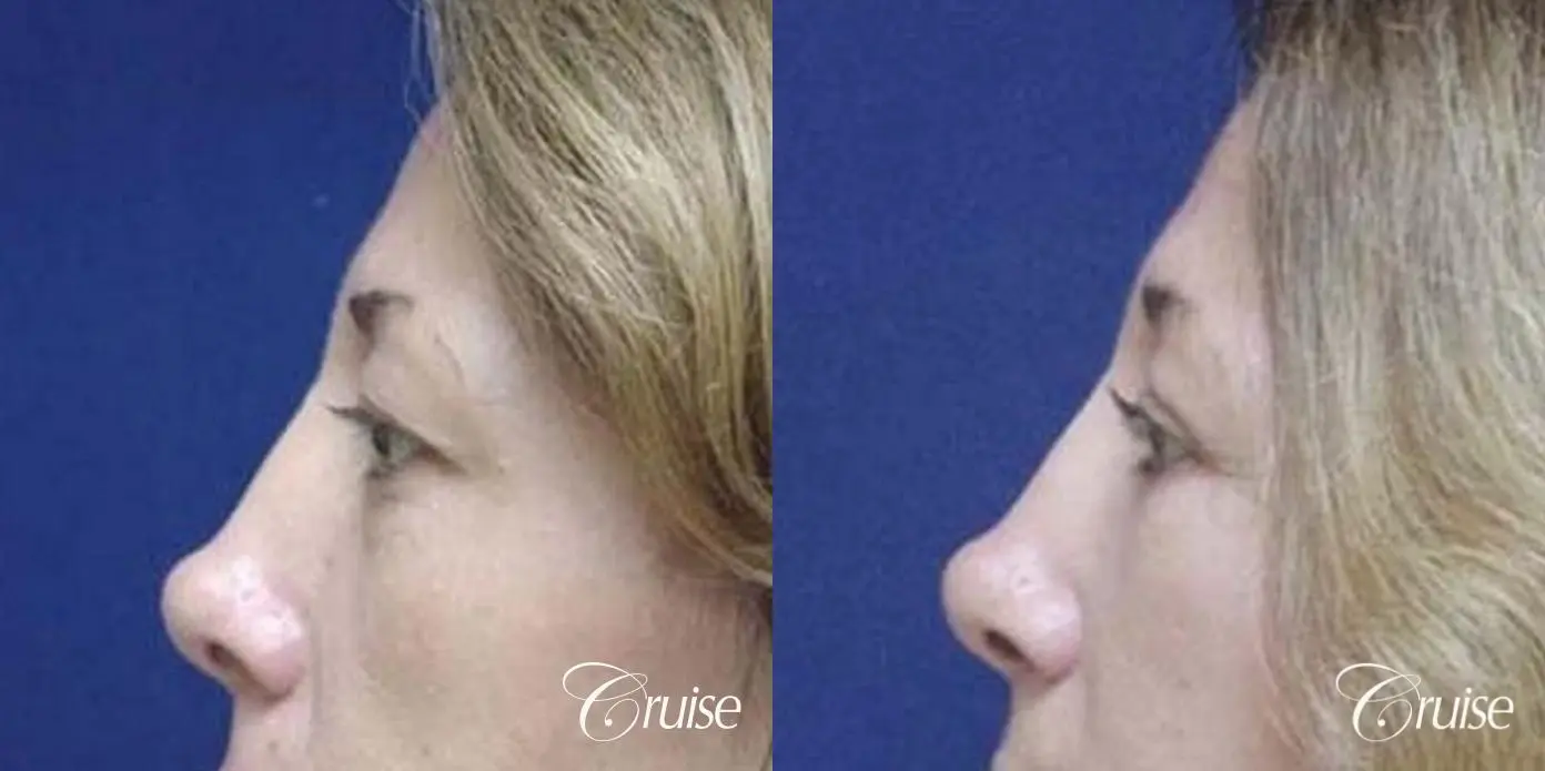 Fat Transfer - Lower Lids, Tear Trough - Before and After 3