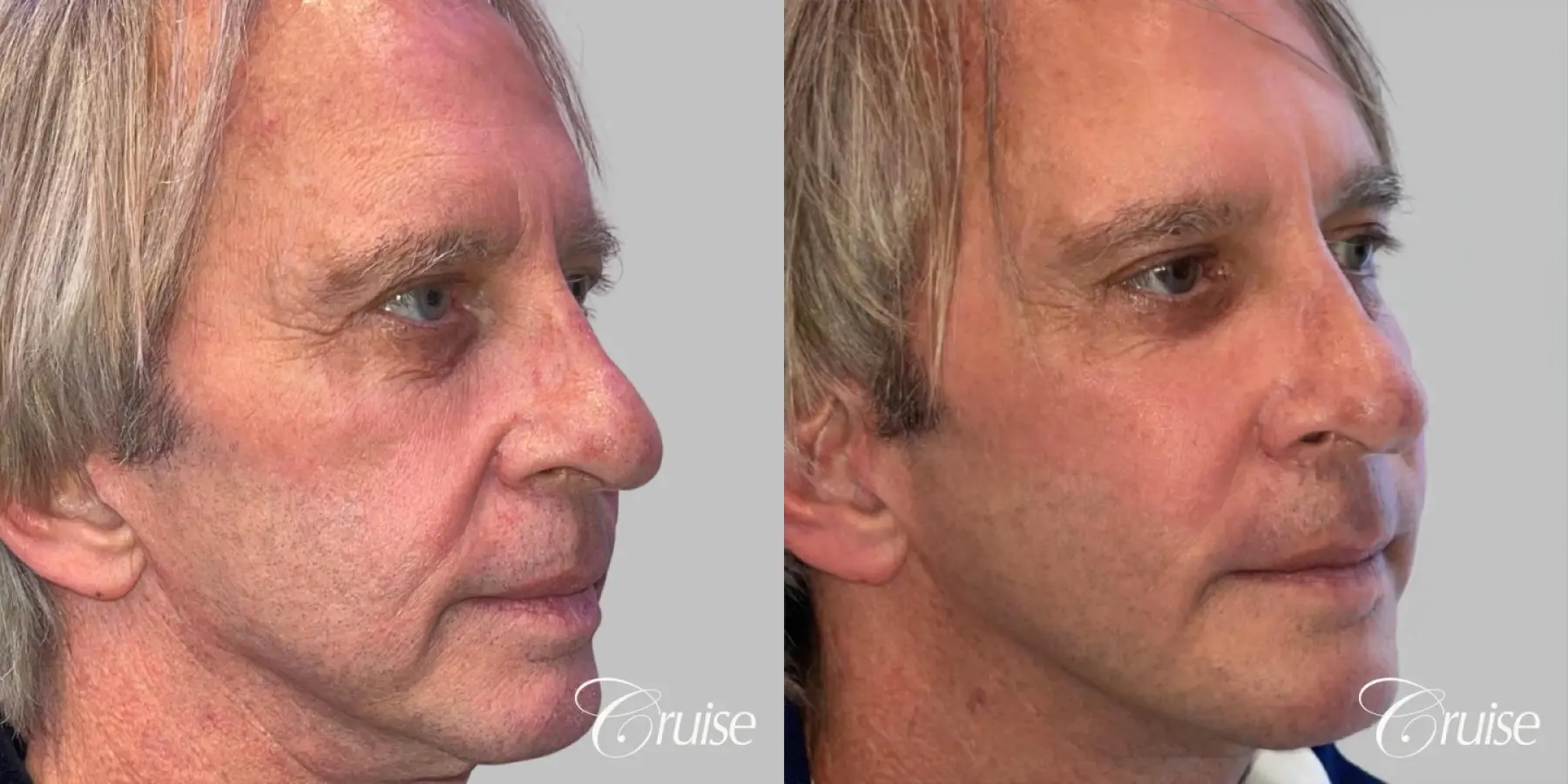 Fat Transfer - Cheeks, Tear Trough, Nasal Labial Folds - Male Patient - Before and After 2