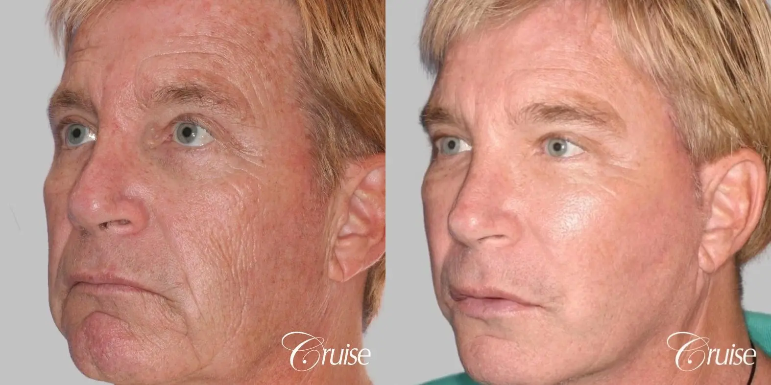 Male Facelift, Browlift, and Fat Transfer - Before and After 2