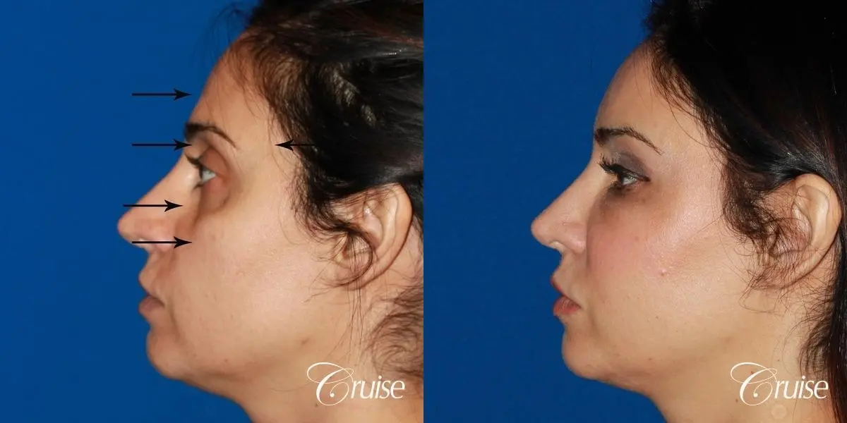 Fat Transfer - Face: Patient 17 - Before and After 2