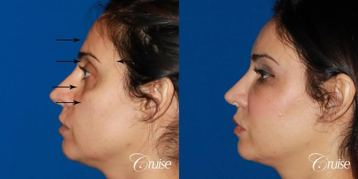 Fat Transfer - Face: Patient 35 - Before and After 2