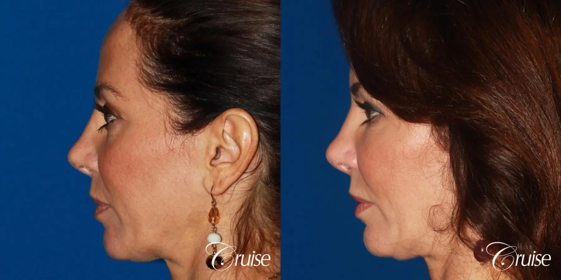 Fat Transfer - Face: Patient 36 - Before and After 2