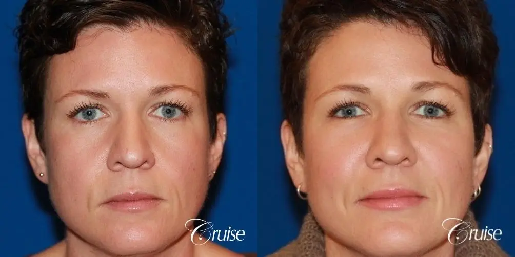 Fat Transfer - Face: Patient 26 - Before and After 1