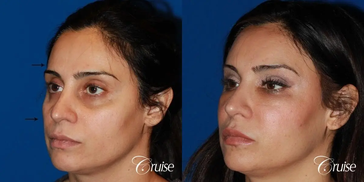 Fat Transfer - Face: Patient 35 - Before and After 3