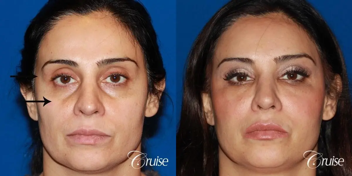 Fat Transfer - Face: Patient 17 - Before and After  