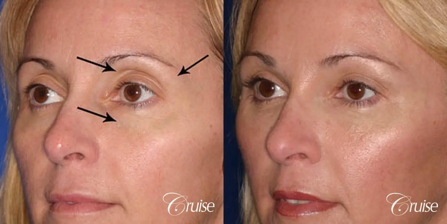 Fat Transfer - Tear Trough, Upper-Lids, Temple - Before and After 2