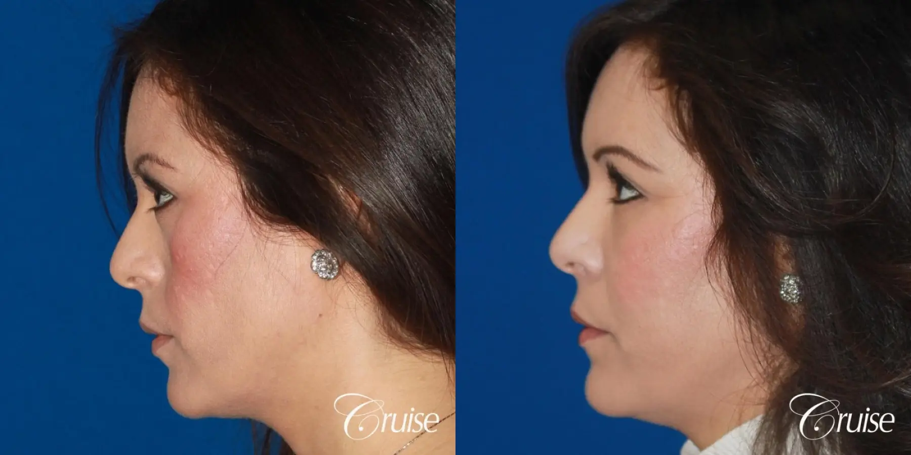 Fat Transfer - Face: Patient 2 - Before and After 2